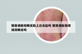 銀屑病做雙眼皮臉上還會(huì)起嗎 銀屑病能做埋線雙眼皮嗎
