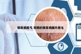 銀屑病眉弓 初期的銀屑病圖片眉毛