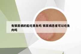 有銀屑病的能吃黑魚嗎 銀屑病患者可以吃魚肉嗎