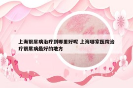 上海銀屑病治療到哪里好呢 上海哪家醫(yī)院治療銀屑病最好的地方