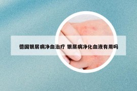 德國(guó)銀屑病凈血治療 銀屑病凈化血液有用嗎