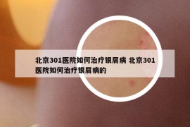 北京301醫(yī)院如何治療銀屑病 北京301醫(yī)院如何治療銀屑病的