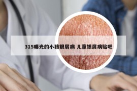315曝光的小孩銀屑病 兒童銀屑病貼吧