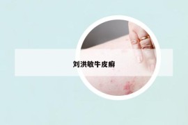 劉洪敏牛皮癬