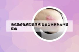 類克治療膿皰型銀屑病 類克生物制劑治療銀屑病