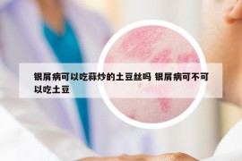 銀屑病可以吃蒜炒的土豆絲嗎 銀屑病可不可以吃土豆