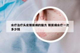 水療治療頭皮銀屑病的偏方 銀屑病水療一次多少錢(qián)
