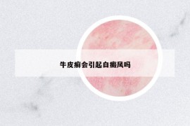 牛皮癬會引起白癜風嗎