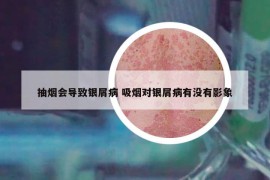 抽煙會導(dǎo)致銀屑病 吸煙對銀屑病有沒有影象