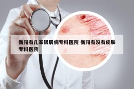 衡陽有幾家銀屑病?？漆t(yī)院 衡陽有沒有皮膚?？漆t(yī)院