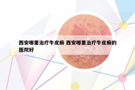 西安哪里治療牛皮癬 西安哪里治療牛皮癬的醫(yī)院好
