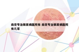 南京專治銀屑病醫(yī)院有 南京專治銀屑病醫(yī)院有幾家