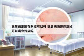銀屑病泡腳在刮掉可以嗎 銀屑病泡腳在刮掉可以嗎會傳染嗎