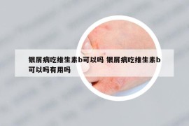 銀屑病吃維生素b可以嗎 銀屑病吃維生素b可以嗎有用嗎