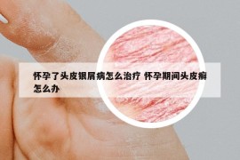 懷孕了頭皮銀屑病怎么治療 懷孕期間頭皮癬怎么辦