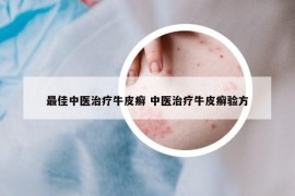 最佳中醫(yī)治療牛皮癬 中醫(yī)治療牛皮癬驗方