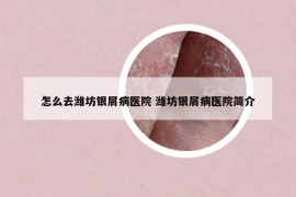 怎么去濰坊銀屑病醫(yī)院 濰坊銀屑病醫(yī)院簡介