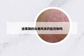 進(jìn)展期的白癜風(fēng)抹藥能控制嗎