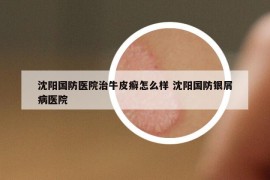 沈陽國防醫(yī)院治牛皮癬怎么樣 沈陽國防銀屑病醫(yī)院