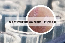 猩紅熱會加重銀屑病嗎 猩紅熱一定會脫屑嗎