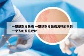 一鍵識(shí)別皮膚病 一鍵識(shí)別皮膚病怎樣能查到一個(gè)人的家庭地址