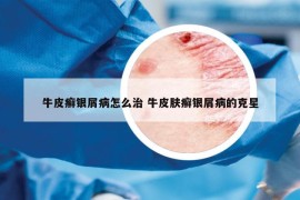 牛皮癬銀屑病怎么治 牛皮膚癬銀屑病的克星