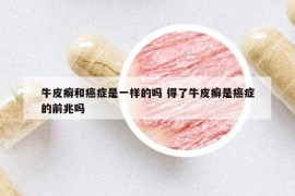 牛皮癬和癌癥是一樣的嗎 得了牛皮癬是癌癥的前兆嗎