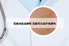 花椒水能治癬嗎 花椒可以治療體蘚嗎