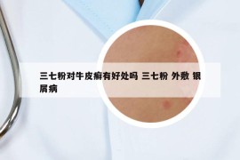 三七粉對(duì)牛皮癬有好處嗎 三七粉 外敷 銀屑病