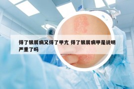 得了銀屑病又得了甲亢 得了銀屑病甲是說(shuō)明嚴(yán)重了嗎