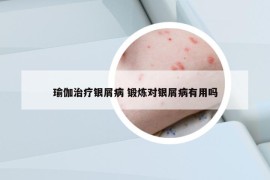 瑜伽治療銀屑病 鍛煉對(duì)銀屑病有用嗎