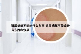 銀屑病都不能吃什么東西 銀屑病都不能吃什么東西和水果