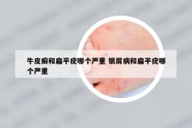 牛皮癬和扁平疣哪個嚴重 銀屑病和扁平疣哪個嚴重