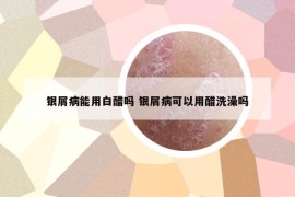 銀屑病能用白醋嗎 銀屑病可以用醋洗澡嗎