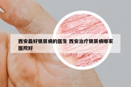 西安最好銀屑病的醫(yī)生 西安治療銀屑病哪家醫(yī)院好
