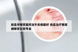南昌市哪家醫(yī)院治牛皮癬最好 南昌治療銀屑病哪家比較專業(yè)