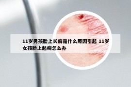 11歲男孩臉上長(zhǎng)癬是什么原因引起 11歲女孩臉上起癬怎么辦