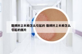 胳膊肘上長(zhǎng)癬怎么引起的 胳膊肘上長(zhǎng)癬怎么引起的圖片