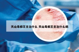 天山毒癬王主治什么 天山毒癬王主治什么病