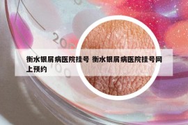 衡水銀屑病醫(yī)院掛號 衡水銀屑病醫(yī)院掛號網上預約