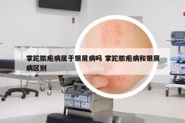 掌跎膿皰病屬于銀屑病嗎 掌跎膿皰病和銀屑病區(qū)別