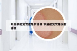 銀屑病的復發(fā)跡象有哪些 銀屑病復發(fā)原因有哪些