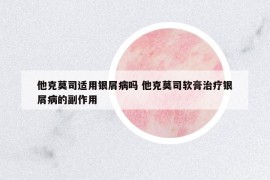 他克莫司適用銀屑病嗎 他克莫司軟膏治療銀屑病的副作用