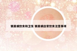 銀屑病飲食和衛(wèi)生 銀屑病日常飲食注意事項(xiàng)