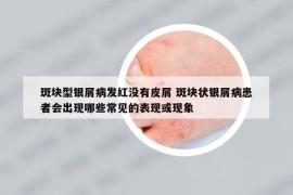 斑塊型銀屑病發(fā)紅沒(méi)有皮屑 斑塊狀銀屑病患者會(huì)出現(xiàn)哪些常見(jiàn)的表現(xiàn)或現(xiàn)象