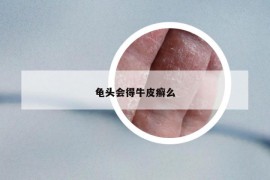 龜頭會得牛皮癬么
