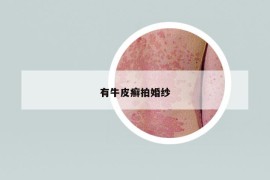 有牛皮癬拍婚紗