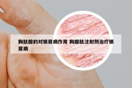 胸肽腺的對銀屑病作用 胸腺肽注射劑治療銀屑病