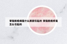 掌指膿皰病是什么原因引起的 掌指膿皰疹是怎么引起的