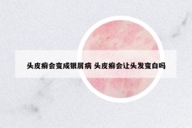 頭皮癬會(huì)變成銀屑病 頭皮癬會(huì)讓頭發(fā)變白嗎